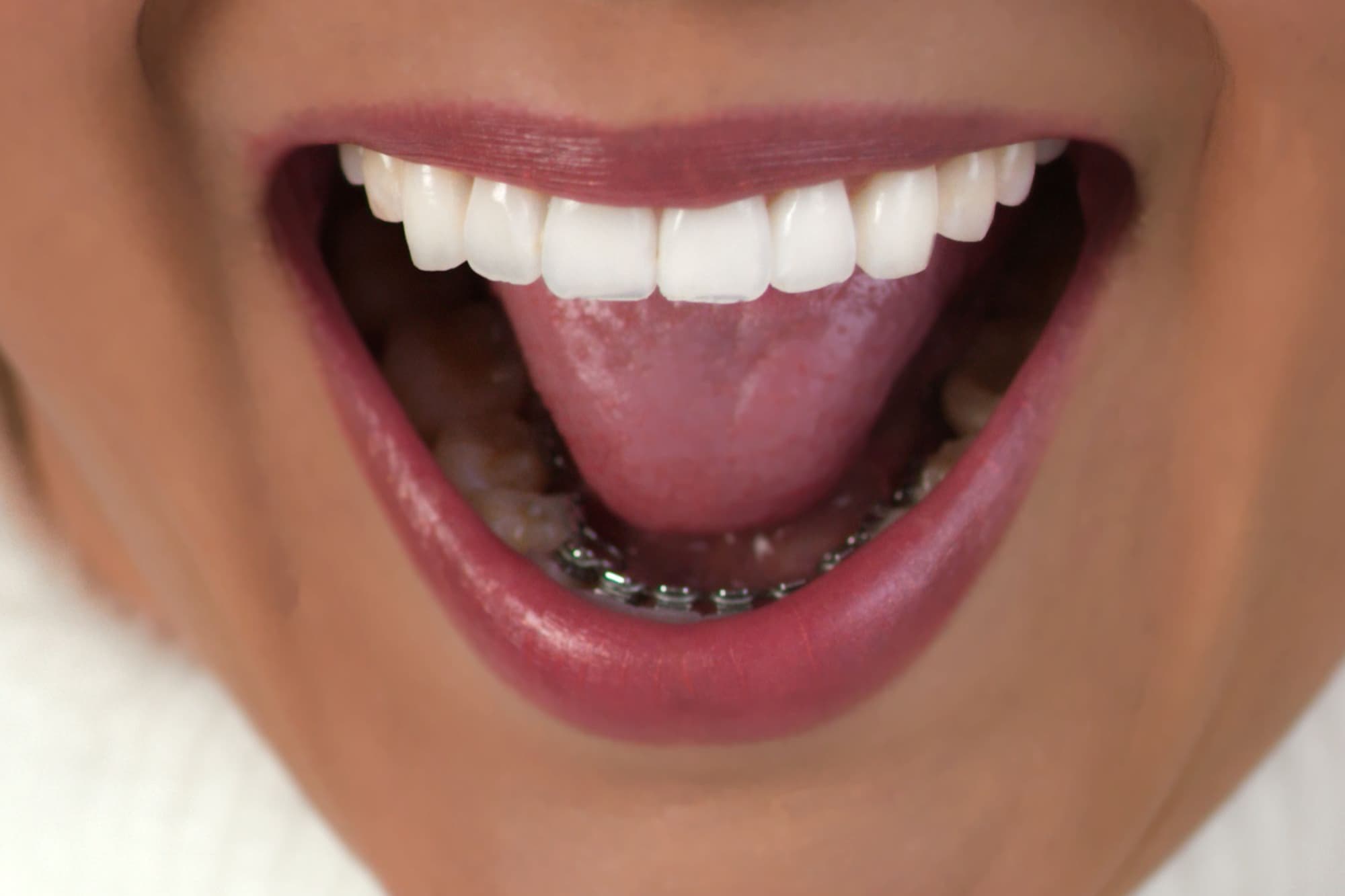 hidden braces image