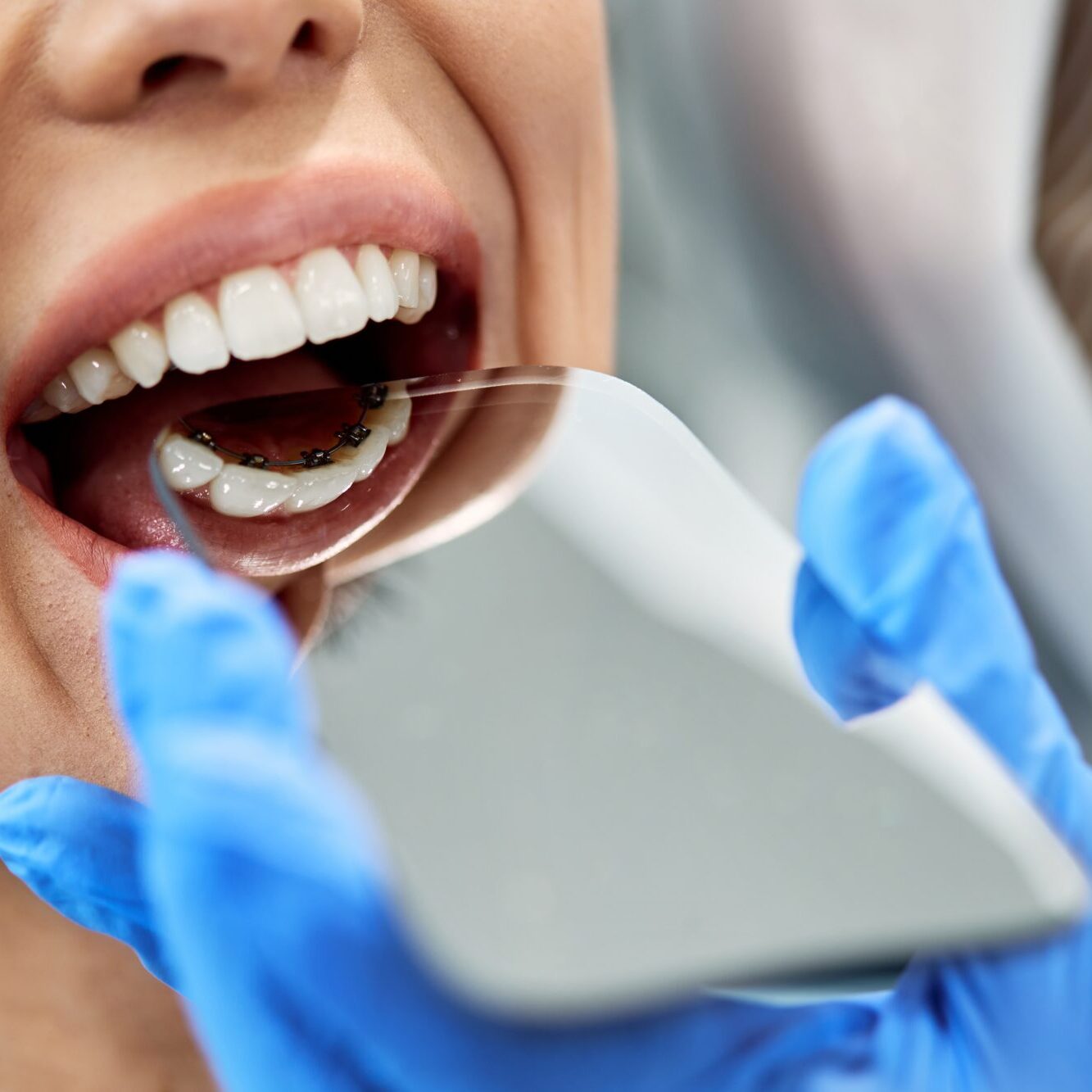 lingual-braces-2